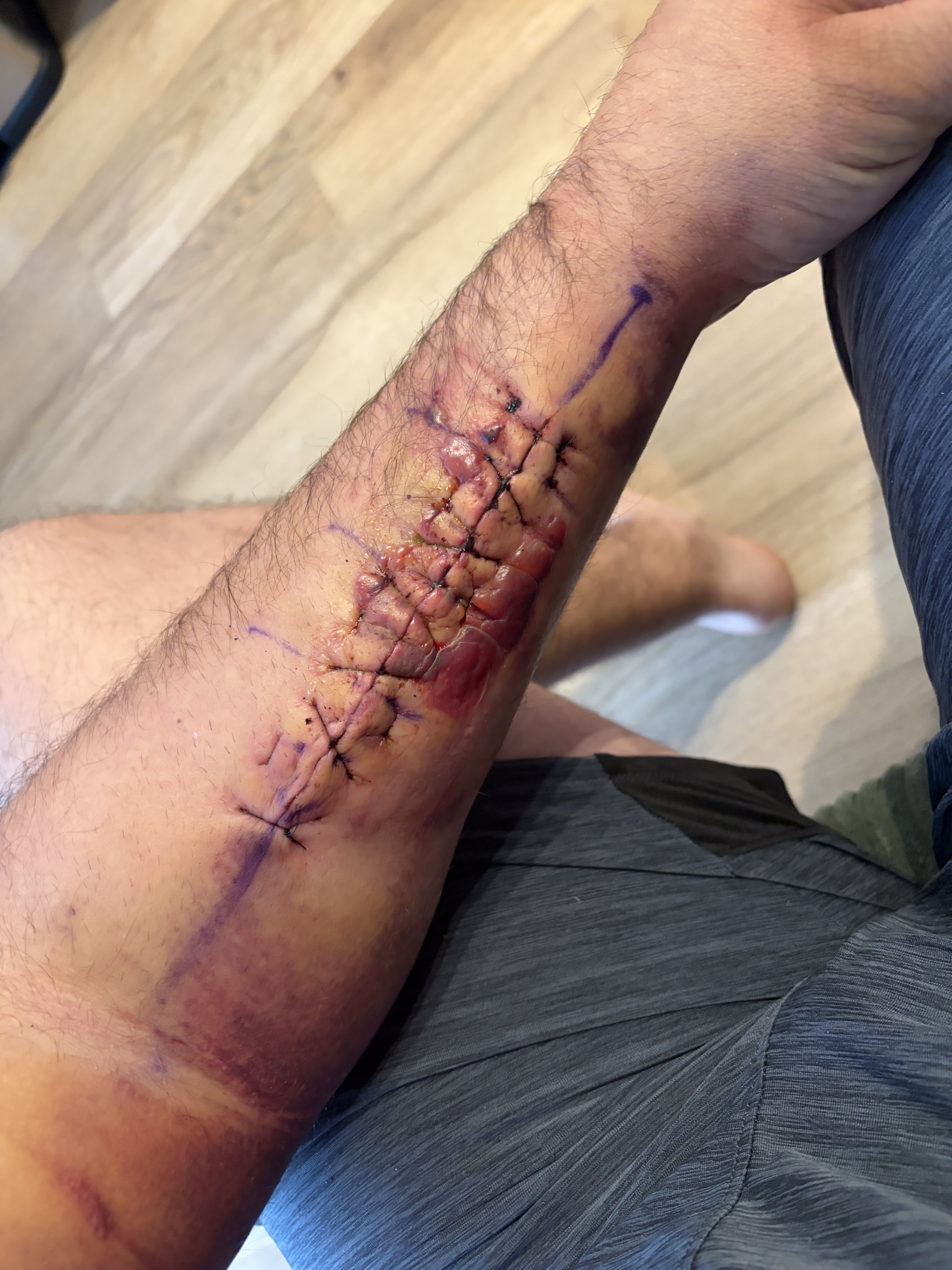 Arm Injury